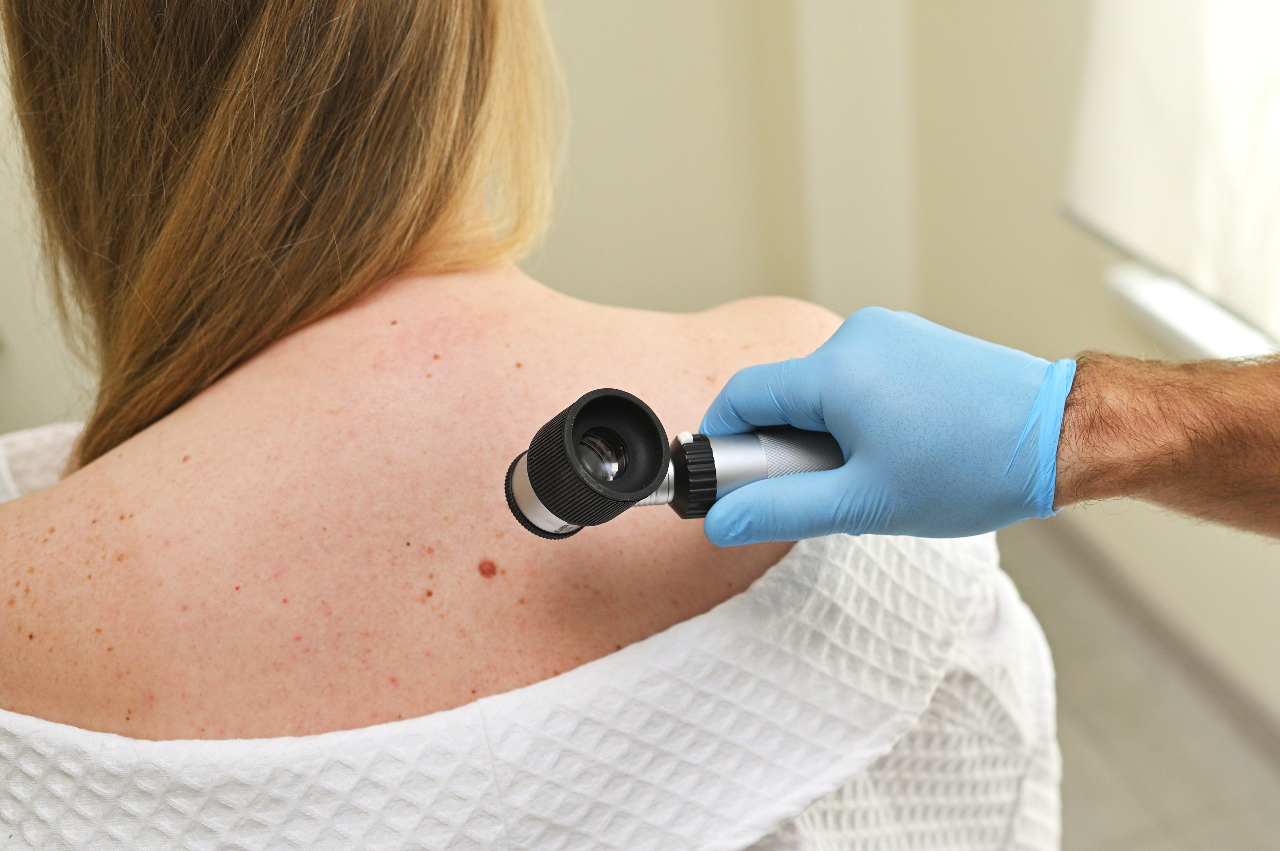 Vacina reduz em 42% o risco de morte ou recidiva de melanoma