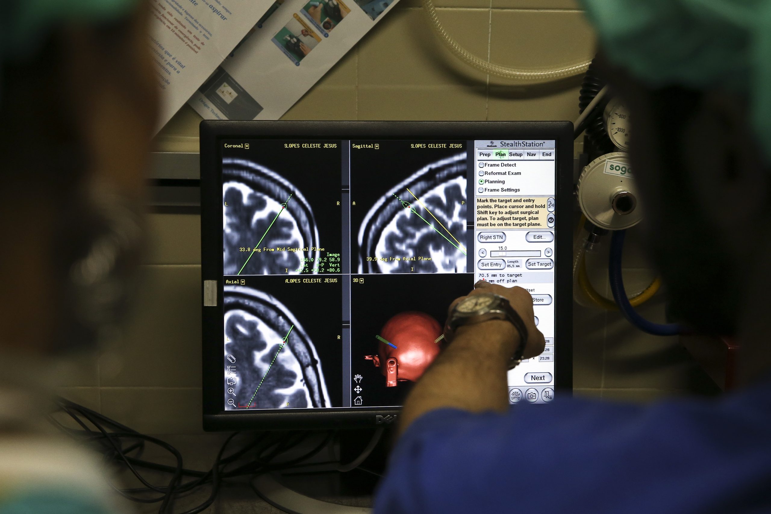 Cientistas portugueses dão mais um passo no tratamento da doença de Parkinson