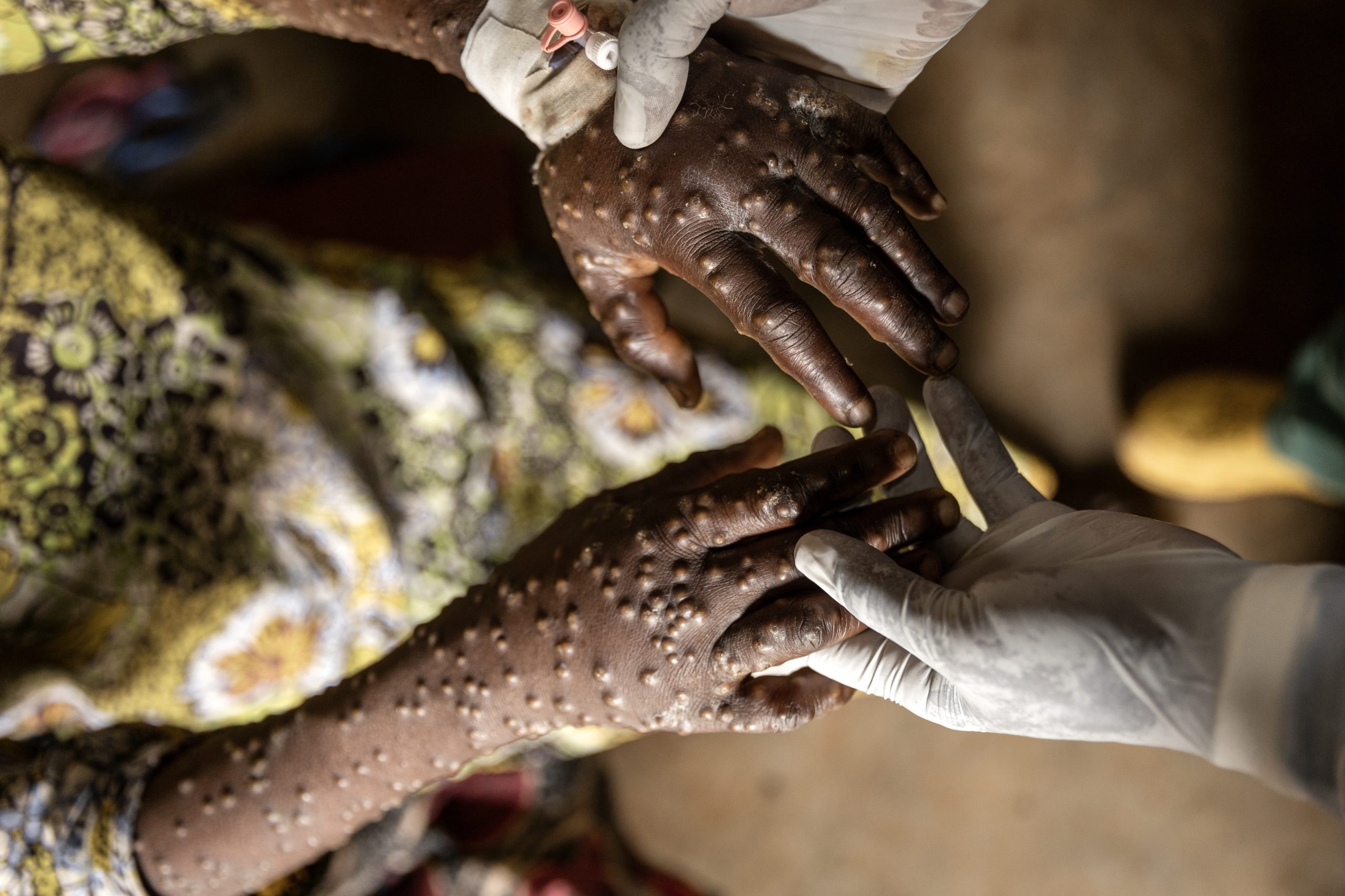 OMS mantém alerta de emergência de saúde global para mpox