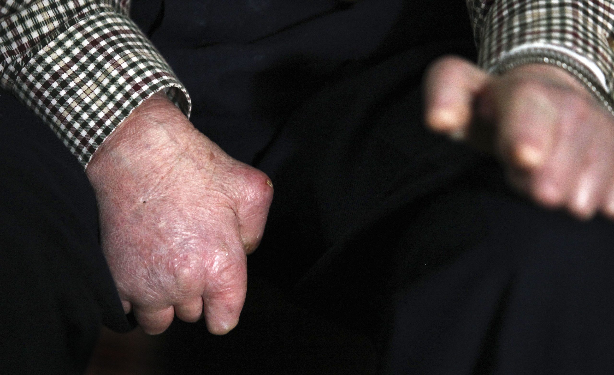 Casos de lepra são raros, mas ainda aparecem em Portugal