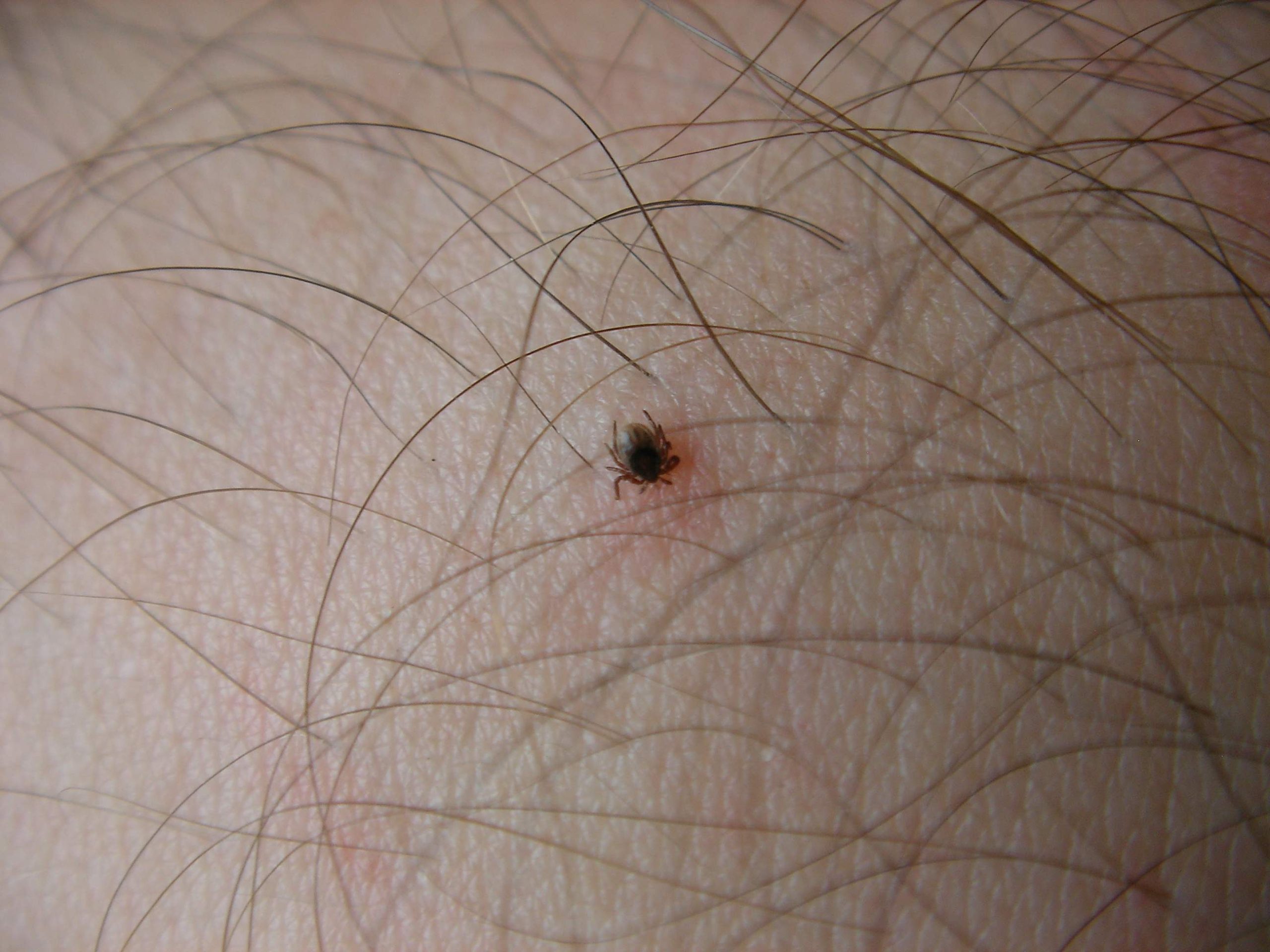 Alterações climáticas fazem doença de Lyme aumentar, mas médicos têm dificuldade em reconhecer sintomas