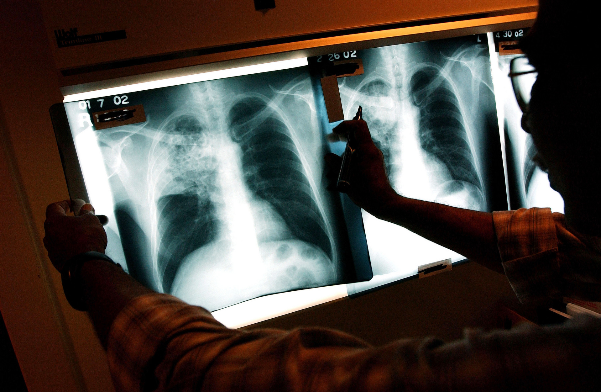 Tuberculose. Estudo defende que doença disseminou-se a partir da Europa mas evoluiu consoante regiões
