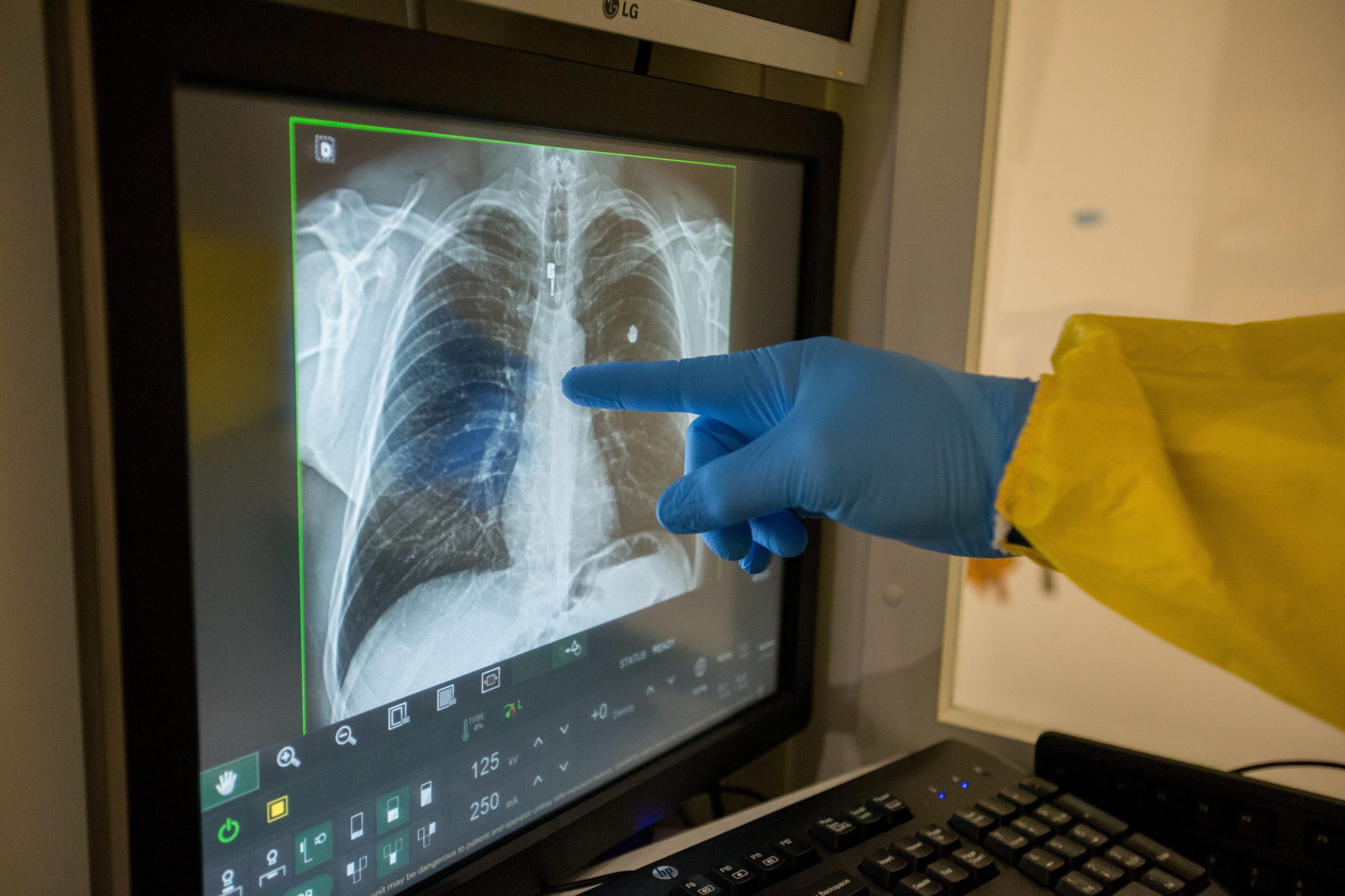 “As sequelas pulmonares da Covid-19 são pouco conhecidas, mas vão aparecendo”