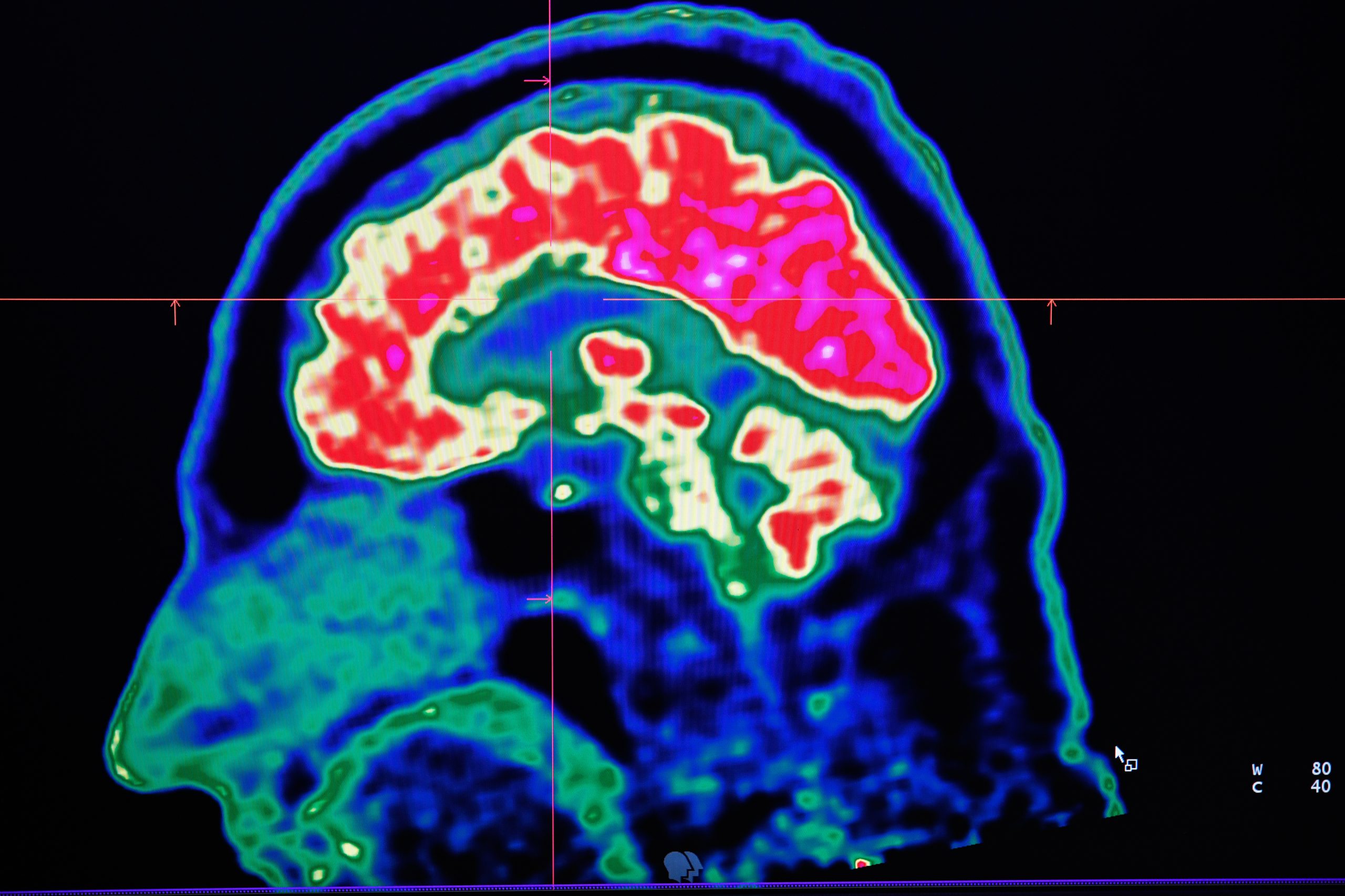 Investigadores do Porto estudam novo fármaco para tratamento do Parkinson