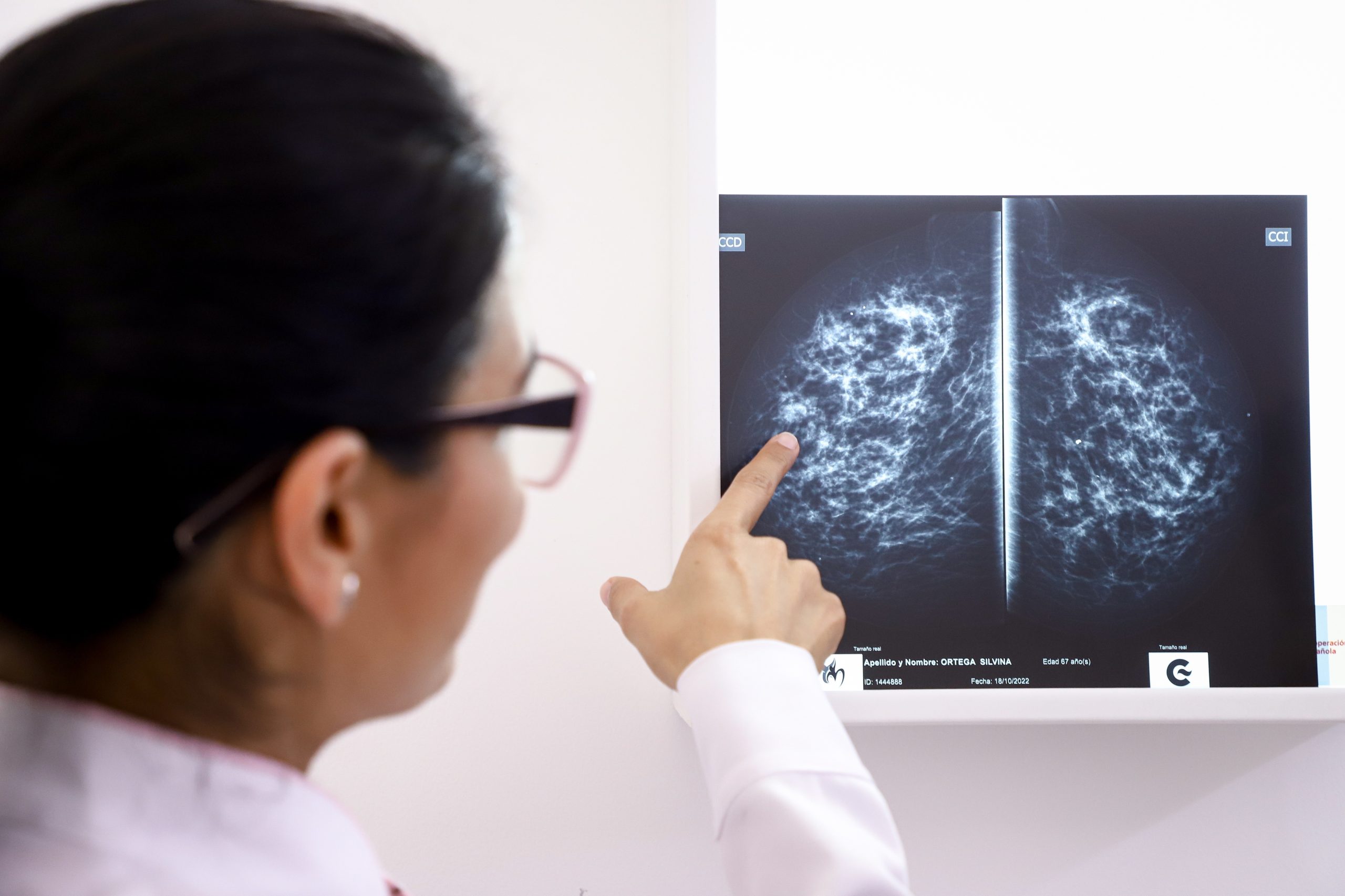 ULS da Lezíria regista “aumento significativo” de cancro da mama em mulheres com menos de 40 anos